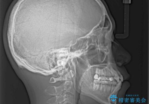 八重歯と前歯のガタガタを抜歯矯正で治療|クリアブラケット使用例の治療前
