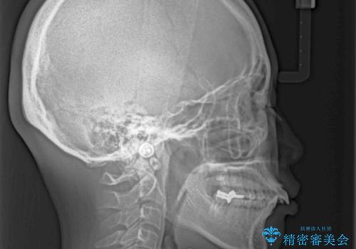 出っ歯を治したい　ワイヤー装置での抜歯矯正の治療前