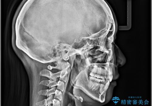 横顔の印象を改善したい ワイヤー装置での抜歯矯正の治療後