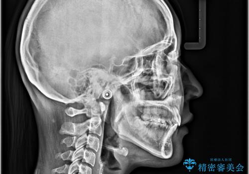 【モニター】デコボコと隠れてしまう前歯 ワイヤー装置による抜歯矯正で美しい口元にの治療後