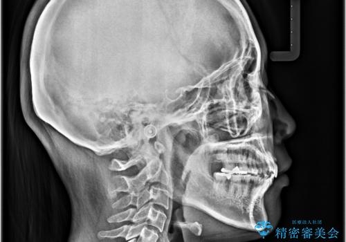 出っ歯を治したい ワイヤー装置での抜歯矯正の治療後