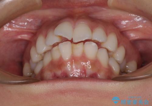 膨らんだ口元を改善する抜歯矯正 インプラント治療も同時に行う総合歯科治療の治療前