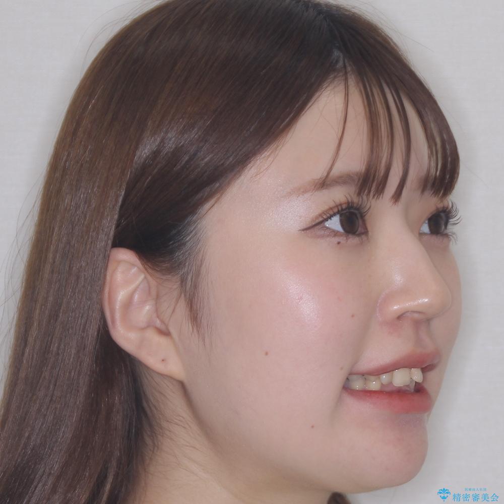 【モニター】デコボコと隠れてしまう前歯 ワイヤー装置による抜歯矯正で美しい口元にの治療前(顔貌)