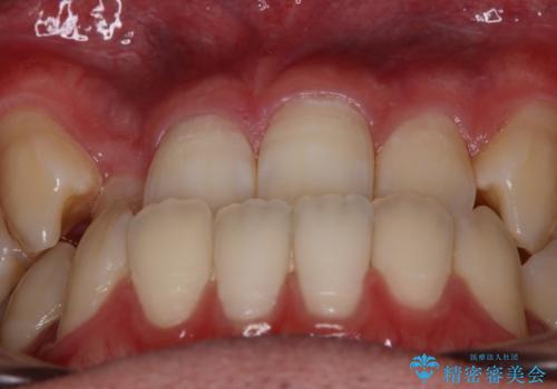 【審美装置】前歯の反対咬合改善の治療前