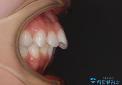 膨らんだ口元を改善する抜歯矯正 インプラント治療も同時に行う総合歯科治療の治療前