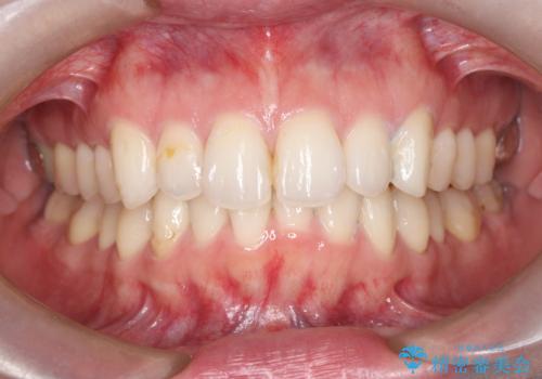 白い歯で思いきり笑える結婚式に!の症例 治療前