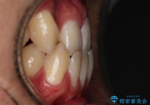 【審美装置】前歯の反対咬合改善の治療前