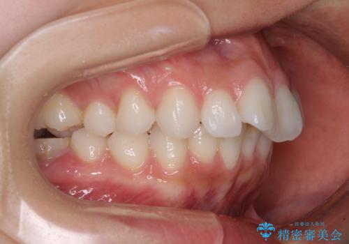 膨らんだ口元を改善する抜歯矯正 インプラント治療も同時に行う総合歯科治療の治療前