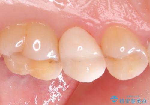 銀歯をやり替えたい 〈セラミッククラウン〉の治療後