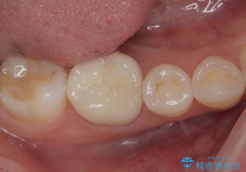 ラバーダム使用で再感染リスクを抑えた再根管治療+精密な補綴による長期安定を実現の治療後