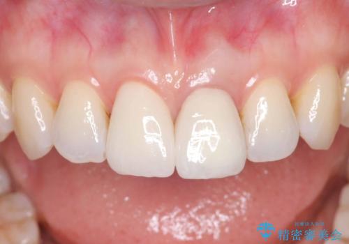 前歯の色が気になる!|他院で抜歯と言われた|歯を残したい|精密根管治療とオールセラミッククラウンで治療の治療後