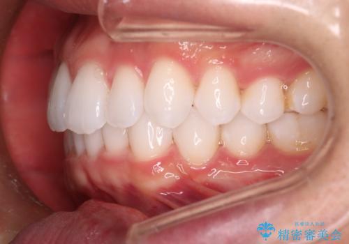 【インビザラインモニター】費用を抑えて歯並び改善!の治療後