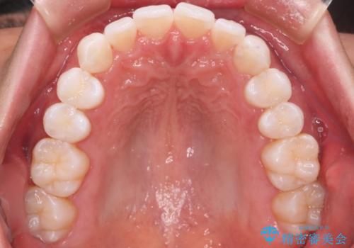 【インビザラインモニター】費用を抑えて歯並び改善!の治療後