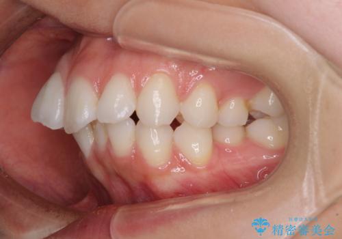膨らんだ口元を改善する抜歯矯正 インプラント治療も同時に行う総合歯科治療の治療前