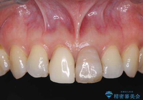 前歯の色が気になる!|他院で抜歯と言われた|歯を残したい|精密根管治療とオールセラミッククラウンで治療の治療前