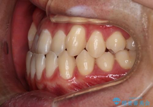 【審美装置】前歯の反対咬合改善の治療前