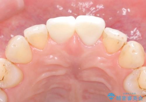 前歯の色が気になる!|他院で抜歯と言われた|歯を残したい|精密根管治療とオールセラミッククラウンで治療の治療後