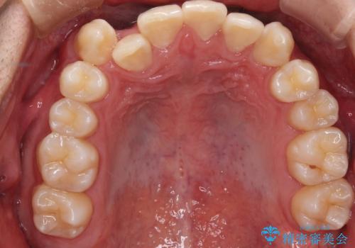 【審美装置】前歯の反対咬合改善の治療前