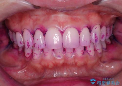 艶感アップになるクリーニングの治療中