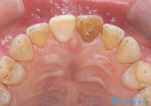 前歯の色が気になる!|他院で抜歯と言われた|歯を残したい|精密根管治療とオールセラミッククラウンで治療の治療前