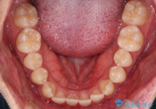 【審美装置】前歯の反対咬合改善の治療前