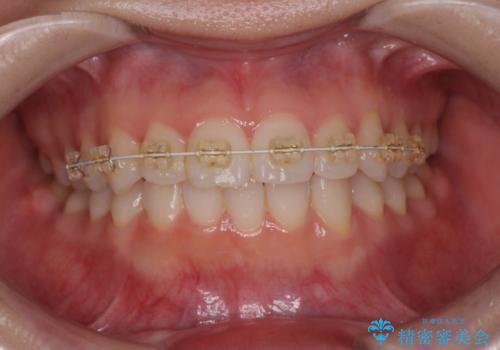 前歯のねじれをきれいに 部分ワイヤー+マウスピース矯正の治療中