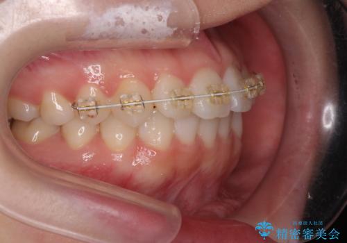 前歯のねじれをきれいに 部分ワイヤー+マウスピース矯正の治療中