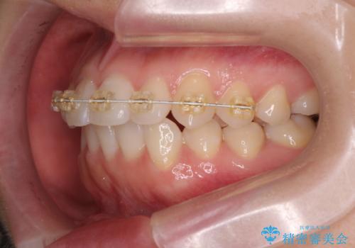 前歯のねじれをきれいに 部分ワイヤー+マウスピース矯正の治療中