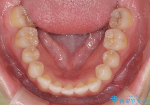 前歯のねじれをきれいに 部分ワイヤー+マウスピース矯正の治療中