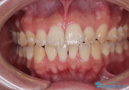 前歯のデコボコをささっと治す 短期間でのインビザライン矯正治療の治療中