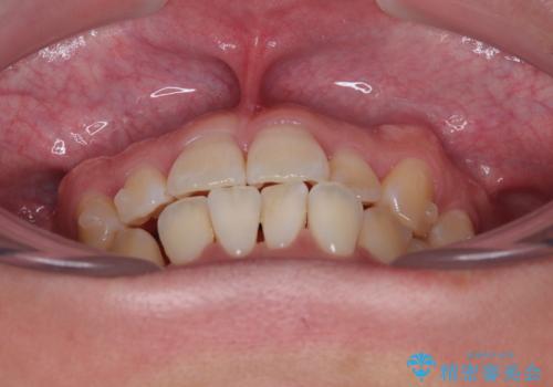 前歯のデコボコをささっと治す 短期間でのインビザライン矯正治療の治療中