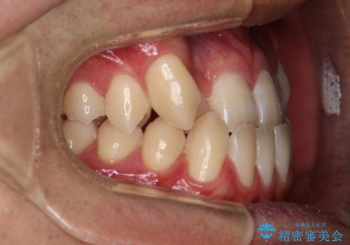 【審美装置】前歯の反対咬合改善の治療前