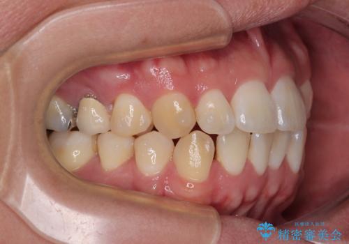 前歯のデコボコをささっと治す 短期間でのインビザライン矯正治療の治療中