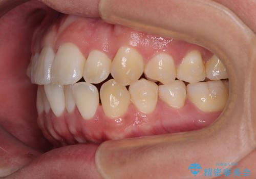 前歯のデコボコをささっと治す 短期間でのインビザライン矯正治療の治療中