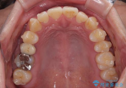 前歯のデコボコをささっと治す 短期間でのインビザライン矯正治療の治療中