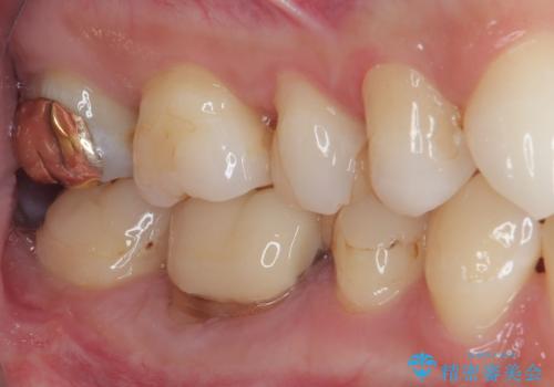 気になる奥歯のむし歯治療の治療後