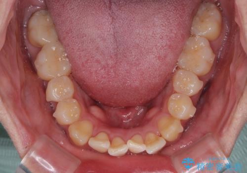 前歯のデコボコをささっと治す 短期間でのインビザライン矯正治療の治療中