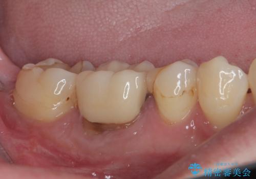 気になる奥歯のむし歯治療の症例 治療後