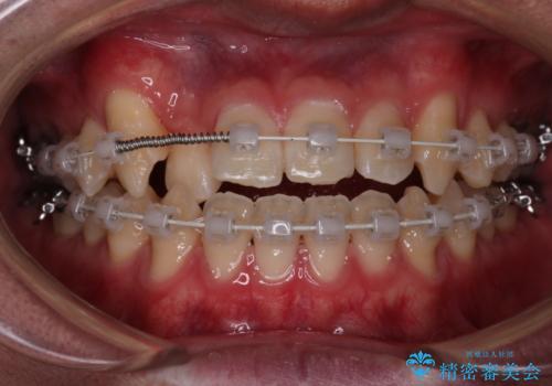 【審美装置】前歯の反対咬合改善の治療中