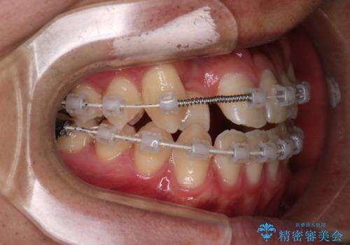【審美装置】前歯の反対咬合改善の治療中