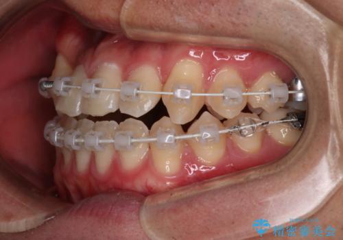 【審美装置】前歯の反対咬合改善の治療中