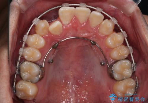 【審美装置】前歯の反対咬合改善の治療中