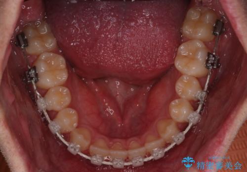【審美装置】前歯の反対咬合改善の治療中