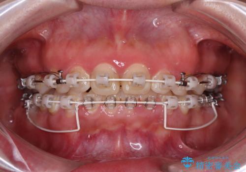 出っ歯を治したい ワイヤー装置での抜歯矯正の治療中