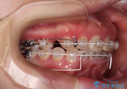出っ歯を治したい ワイヤー装置での抜歯矯正の治療中