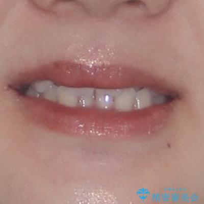 前歯のクロスバイト 裏側に隠れた歯をワイヤー装置で短期間治療の治療前(顔貌)