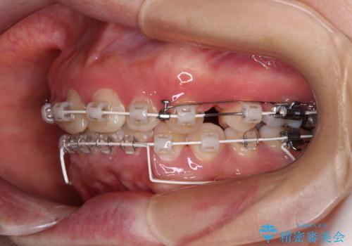 出っ歯を治したい ワイヤー装置での抜歯矯正の治療中