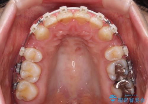 出っ歯を治したい ワイヤー装置での抜歯矯正の治療中