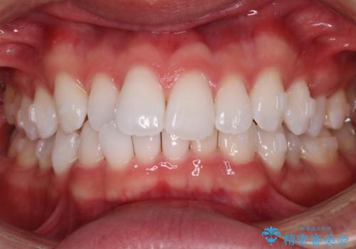 【インビザラインモニター】費用を抑えて歯並び改善!の治療中