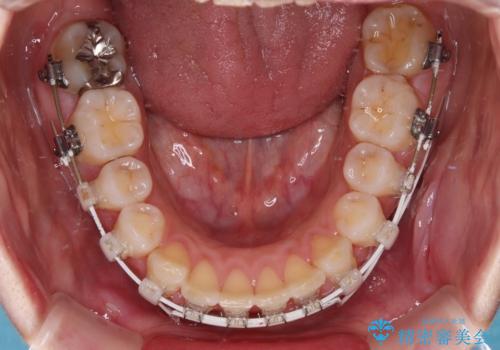 出っ歯を治したい ワイヤー装置での抜歯矯正の治療中